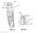 Fig. 16 - CONDENSING SKELETAL IMPLANT THAT FACILITATE INSERTIONS