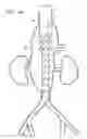 Fig. 16 - Vascular repair devices and methods of use