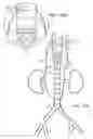 Fig. 17 - Vascular repair devices and methods of use