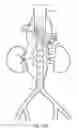 Fig. 19 - Vascular repair devices and methods of use