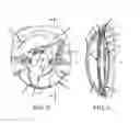 Fig. 03 - Intraocular cell migration inhibition system