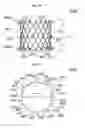 Fig. 07 - Stent member, artificial valve, and method of implanting the same