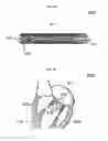 Fig. 11 - Stent member, artificial valve, and method of implanting the same