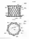 Fig. 18 - Stent member, artificial valve, and method of implanting the same