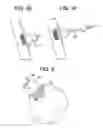 Fig. 08 - Aspirating Implants and Method of Bony Regeneration