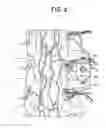 Fig. 11 - Aspirating Implants and Method of Bony Regeneration