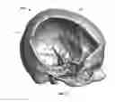 Fig. 03 - Patient-specific craniofacial implants