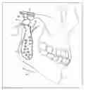 Fig. 01 - Prosthesis