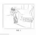 Fig. 02 - Prosthesis