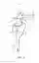 Fig. 04 - Prosthesis