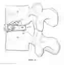 Fig. 05 - Intervertebral disc prosthesis and method