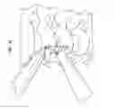 Fig. 35 - Intervertebral disc and insertion methods therefor