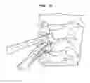Fig. 41 - Intervertebral disc and insertion methods therefor