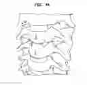 Fig. 43 - Intervertebral disc and insertion methods therefor