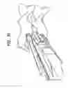 Fig. 51 - Intervertebral disc and insertion methods therefor