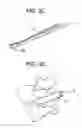 Fig. 04 - Minimally invasive intervertebral staple distraction devices