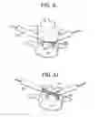 Fig. 08 - Minimally invasive intervertebral staple distraction devices