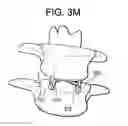 Fig. 10 - Minimally invasive intervertebral staple distraction devices