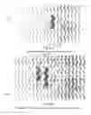 Fig. 06 - Crimping polymer scaffolds