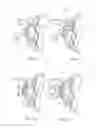Fig. 05 - Method of altering the refractive properties of an eye
