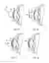 Fig. 08 - Method of altering the refractive properties of an eye