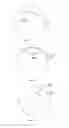 Fig. 20 - Method of altering the refractive properties of an eye