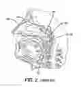 Fig. 03 - Low profile eustachian tube dilation system