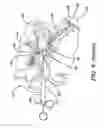 Fig. 05 - Low profile eustachian tube dilation system