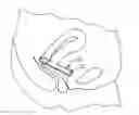 Fig. 01 - Cervical pad