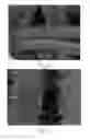 Fig. 10 - Absorbent articles with nonwoven substrates having fibrils