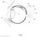 Fig. 03 - Method for forming a molded two-layer ocular implant