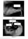 Fig. 15 - Peripheral nerve growth conduit