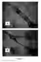 Fig. 16 - Peripheral nerve growth conduit