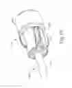 Fig. 10 - Balloon catheter assembly