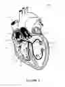 Fig. 02 - Anti-Arrhythmia Devices And Methods Of Use