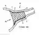 Fig. 06 - Anti-Arrhythmia Devices And Methods Of Use