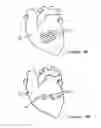 Fig. 16 - Anti-Arrhythmia Devices And Methods Of Use