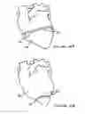 Fig. 17 - Anti-Arrhythmia Devices And Methods Of Use