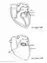 Fig. 19 - Anti-Arrhythmia Devices And Methods Of Use