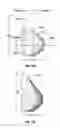 Fig. 11 - Systems and methods for a tissue expander