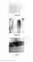 Fig. 03 - TRANSPLANTATION DEVICE AND METHOD OF USE