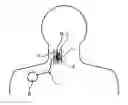Fig. 01 - Implantable device including a stimulation lead for bioimpedance measurement