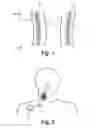Fig. 02 - Implantable device including a stimulation lead for bioimpedance measurement