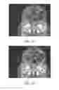 Fig. 05 - Tissue compensator thickness visualization and modification tool for use in radiation treatment planning