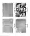 Fig. 04 - IMMUNOHISTOCHEMICAL ASSAY FOR DETECTING EXPRESSION OF PROGRAMMED DEATH LIGAND 1 (PD-L1) IN TUMOR TISSUE