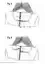 Fig. 04 - Zipper assist device