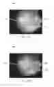 Fig. 07 - Reduced glare surgical microscope and associated devices, systems, and methods