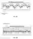 Fig. 05 - Electrocardiograph (ECG) signal processing