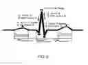 Fig. 06 - Electrocardiograph (ECG) signal processing