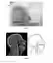 Fig. 07 - Thermoplastic 3-D phantom